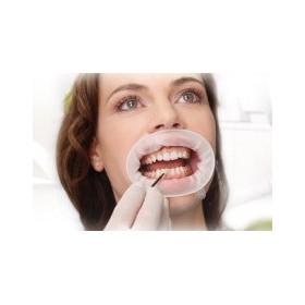 Προσφορά Optragate2 4* 80pcs δώρο Optragate2 1* 80pcs