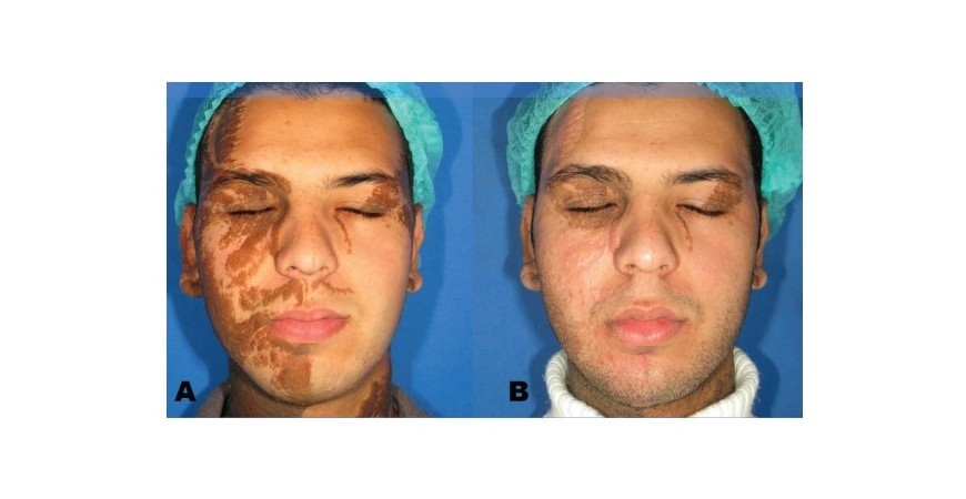 Αντιμετώπιση γιγαντιαίου σπίλου με CO2 laser