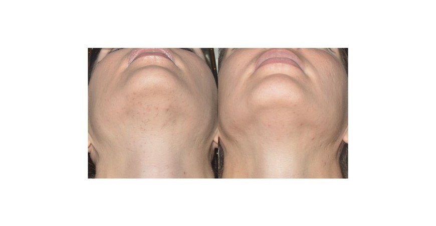 Αφαίρεση ανεπιθύμητης τριχοφυίας - αποτελεσματικότητα , ανεκτικότητα με 755 nm αλεξανδρίτη με ψυχόμενη κεφαλή από ζαφείρι