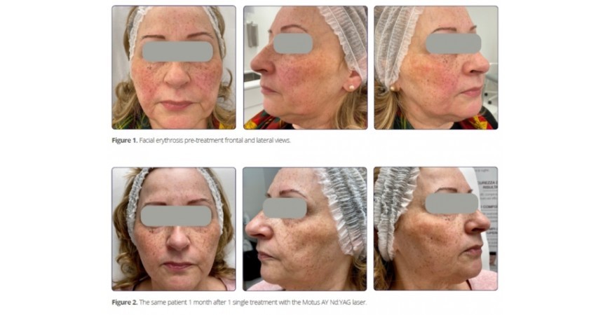 Θεραπεία ροδόχρου και της διάχυτης ερυθρότητας  με NdYag laser